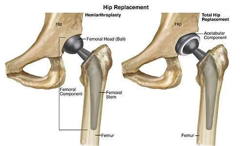 Hip Replacement