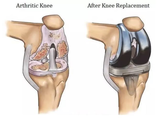 Knee Replacement